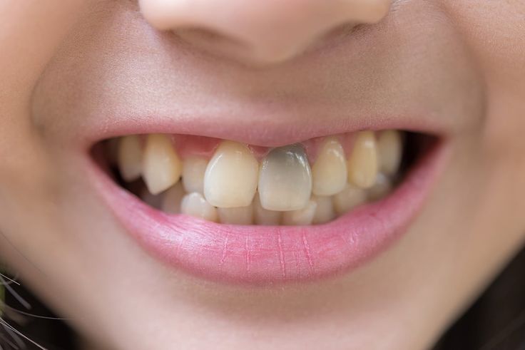 Dente escurecido